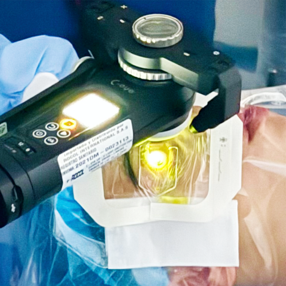 CROSSLINKING CORNEAL